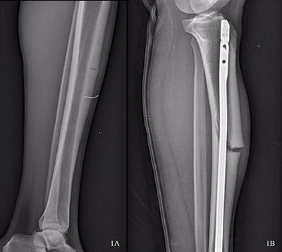 Case Report: Stress Fracture in an International Triple Jumper: Importance of an Integrated Care Approach Which Also Incorporates Biomechanics